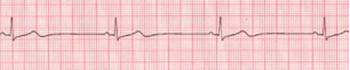 Sinus bradycardia graph