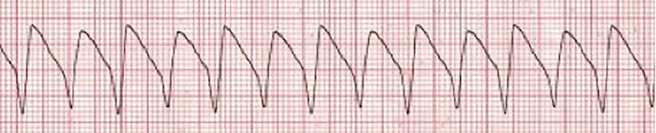 acls rhythm ventricular tachycardia