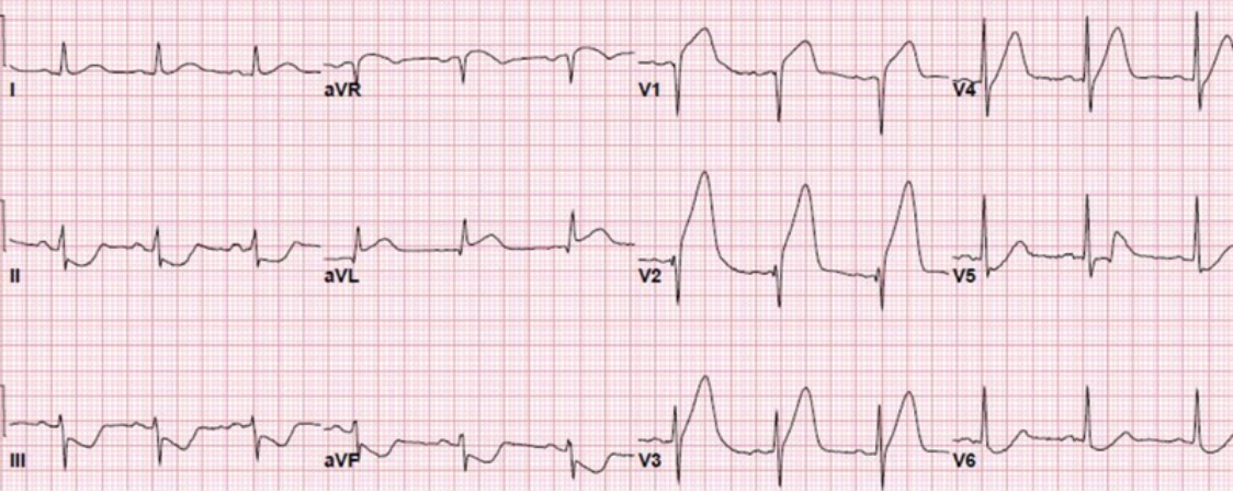 7 anterior stemi