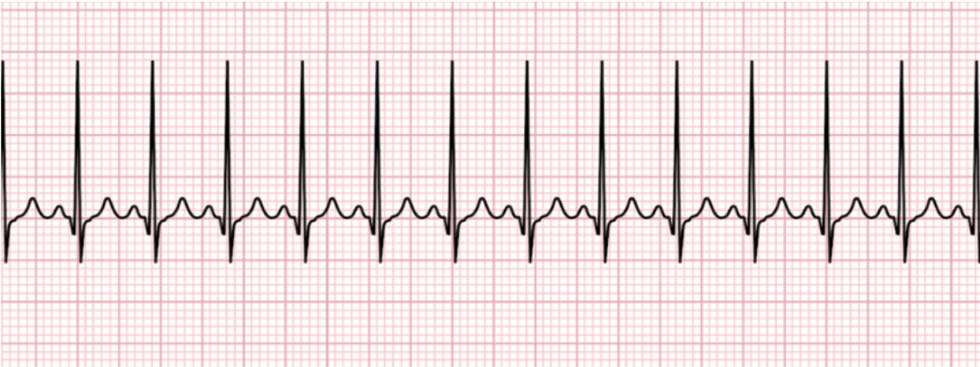 PALS 1 sinus tachycardia