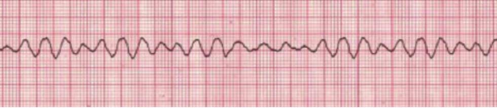 PALS 3 ventricular fibrillation