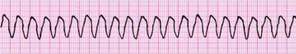 PALS 4 unstable wide complex tachycardia