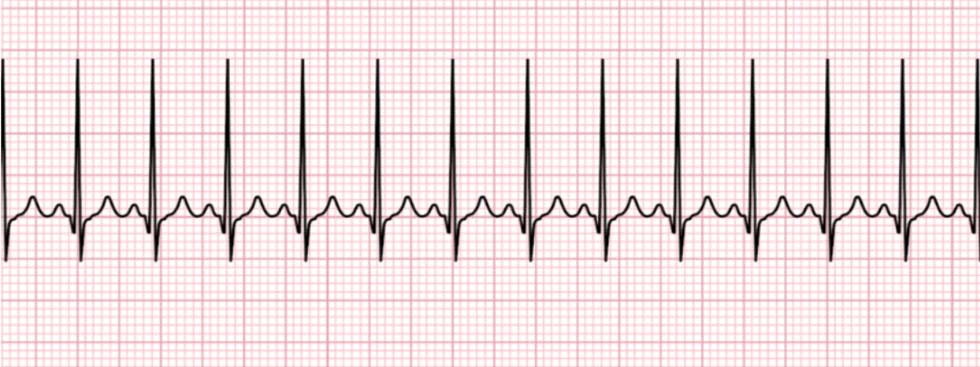 PALS 6 sinus tachycardia