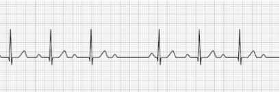 2nd degree AV block Type I (Mobitz Type I, Wenckebach’s)