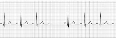 2nd degree AV block Type II (Mobitz Type II)