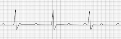 3rd degree AV block (complete heart block, CHB)