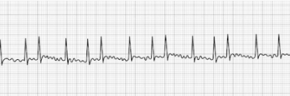 Atrial Fibrillation (aFib)