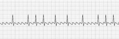 Atrial Flutter