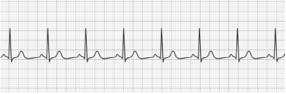 Normal Sinus Rhythm (NSR)