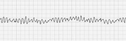 Pulseless Ventricular Fibrillation (vFib)