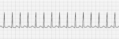 Supraventricular Tachycardia (SVT)