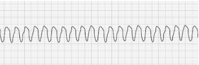 Ventricular Tachycardia (vTach)