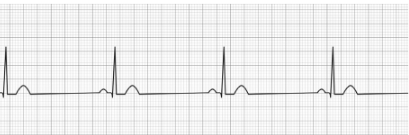 Sinus Bradycardia