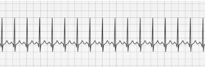 Sinus Tachycardia