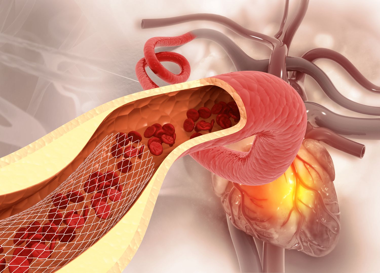 3D medical illustration showing a coronary artery with a stent, depicting a cardiac event related to hemodynamic instability.